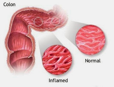 Cara Terbaik untuk Mengobati Stress Incontinence Anda dapat menggunakan perangkat